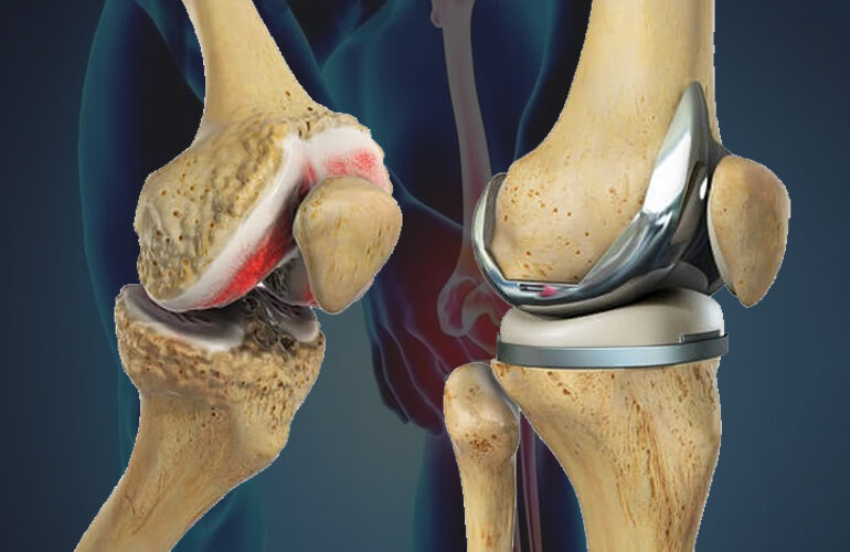 TOTAL KNEE REPLACEMENT image