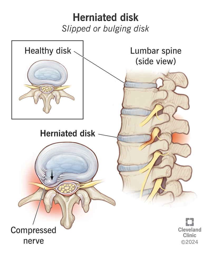 PROLAPSED INTERVERTEBRAL DISC (PID) image
