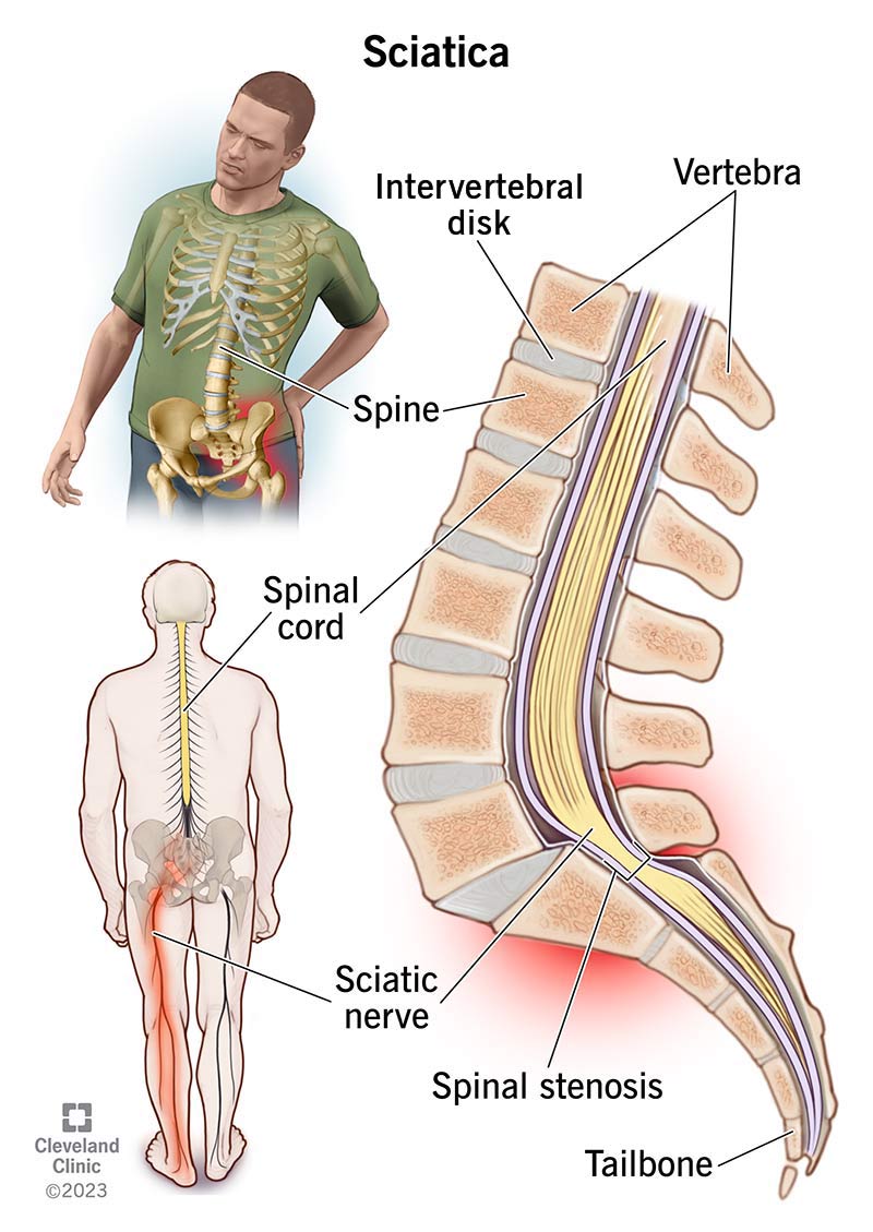 SCIATICA image