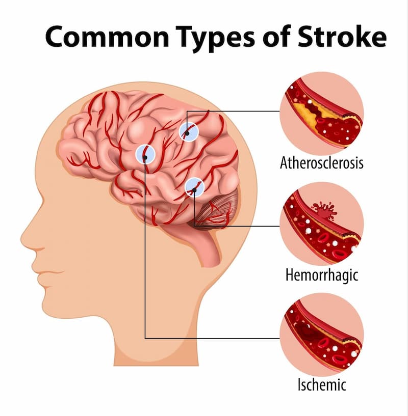 STROKE TREATMENT image