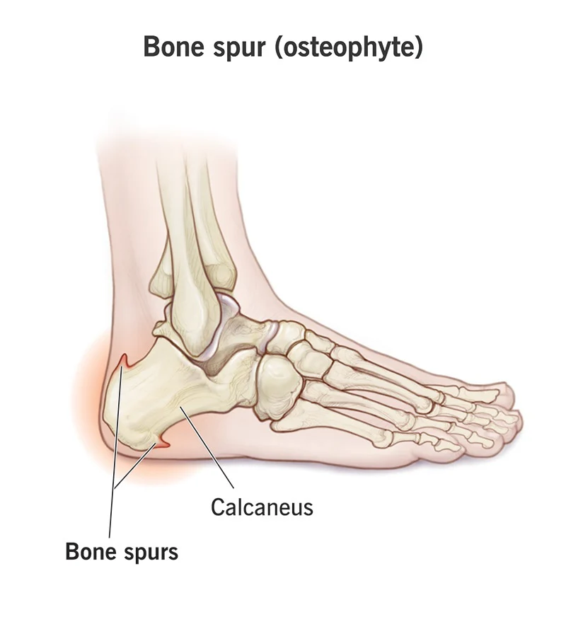 HEEL SPUR (calcaneal spur) image