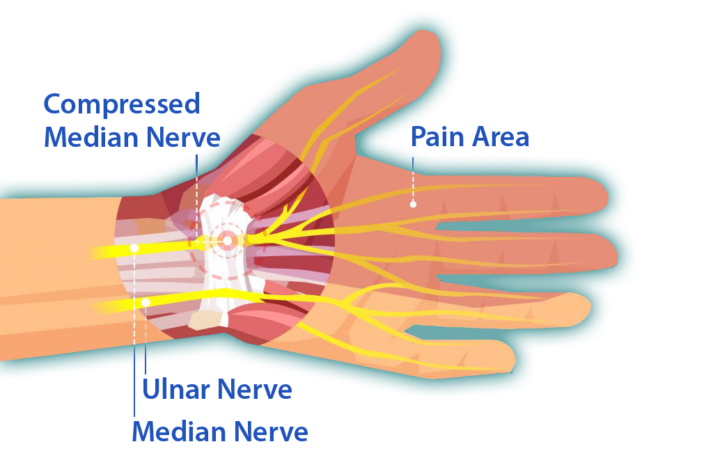 CARPAL TUNNEL SYNDROME image