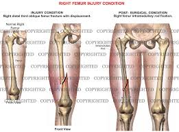 MID SHAFT FEMUR FRACTURE image