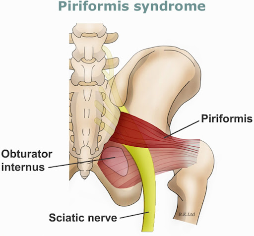 PIRIFORMIS SYNDROME image