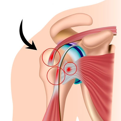 ROTATOR CUFF TENDINITIS image